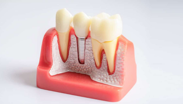 Dental Implants in Mumbai – Dr. Aditi Chhajed