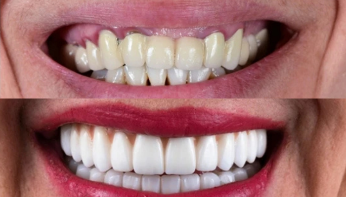 Full Mouth Rehabilitation in Mumbai – Dr. Aditi Chhajed