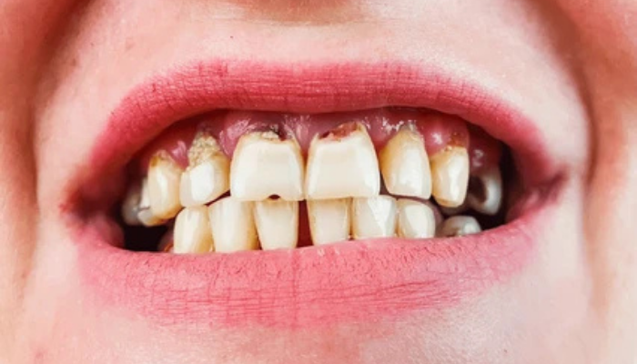 Dental Implants in Mumbai – Dr. Aditi Chhajed