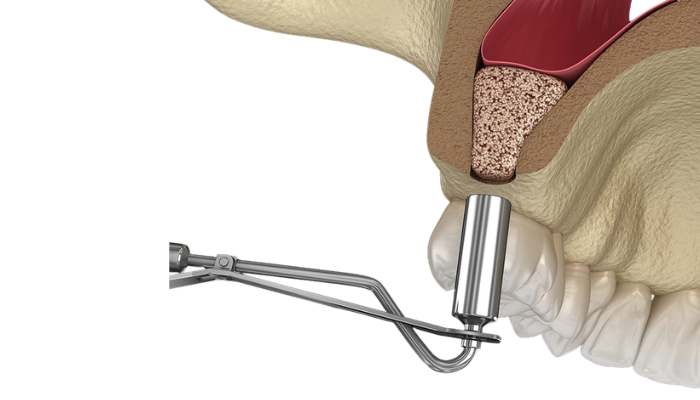 Dental Implants in Mumbai – Dr. Aditi Chhajed