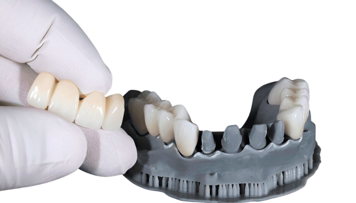 Zirconia Crowns and Bridges in Mumbai – Dr. Aditi Chhajed