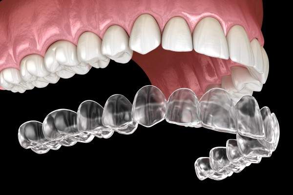 What is Invisalign – Clear Aligners Explained